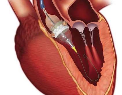 Aortenklappenstenose minimalinvasiv Operieren