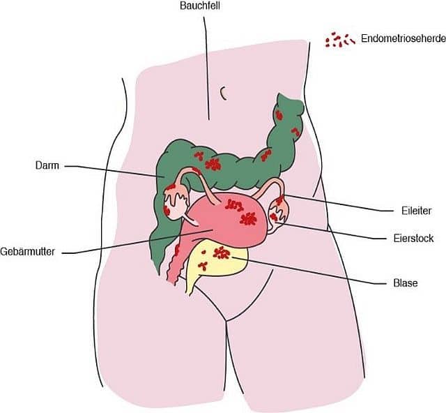 Endometriose bleibt in der Regel lange unentdeckt.