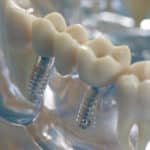 Zahnimplantate bieten gegenüber einem "normalem" Zahnersatz deutliche Vorteile.