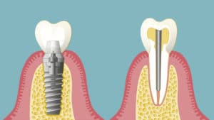 Während ein Stiftzahn in der natürlichen Zahnwurzel verankert ist, fehlt die Zahnwurzel bei einem Implantat.