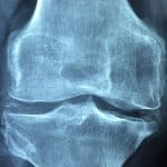2023-04-03-Arthrose