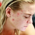 2024-09-19-infrarotlichttherapie